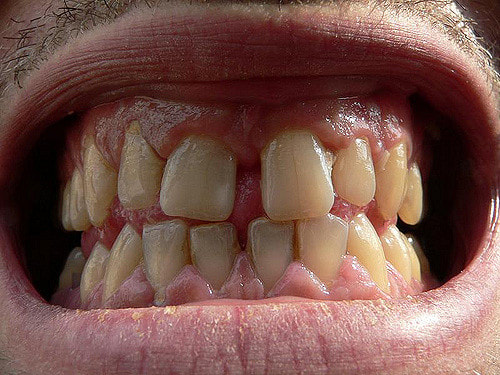  swollen gums